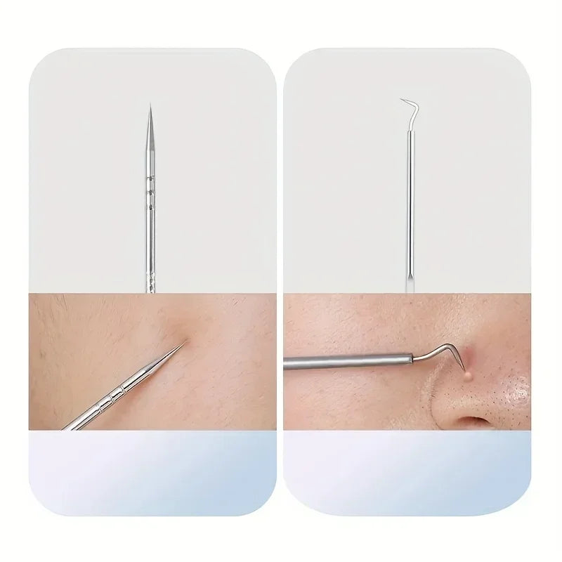 Stainless Steel Acne Extraction Kit For Professional Skincare